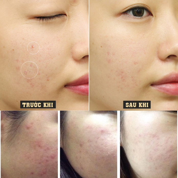 Kem trị mụn thảo dược BeU dùng cho mụn ẩn, mụn nhẹ 20ml