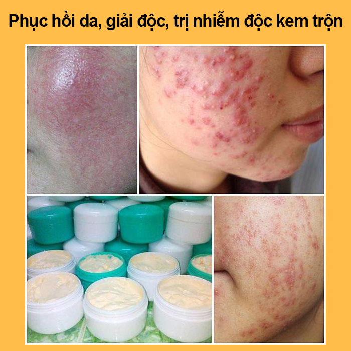 Bột thảo dược đắp mặt phục hồi da, giải độc, trị nhiễm độc kem trộn BeU 150 gram