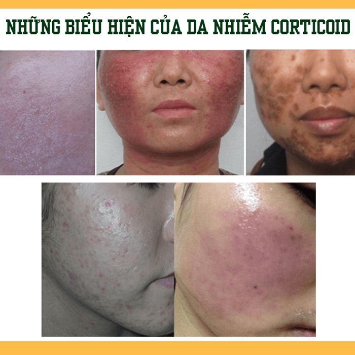 Bột thảo dược đắp mặt phục hồi da, giải độc, trị nhiễm độc kem trộn BeU 150 gram