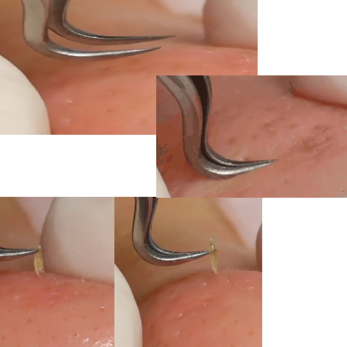 Nhíp Gắp Mụn Thông Minh loại 1